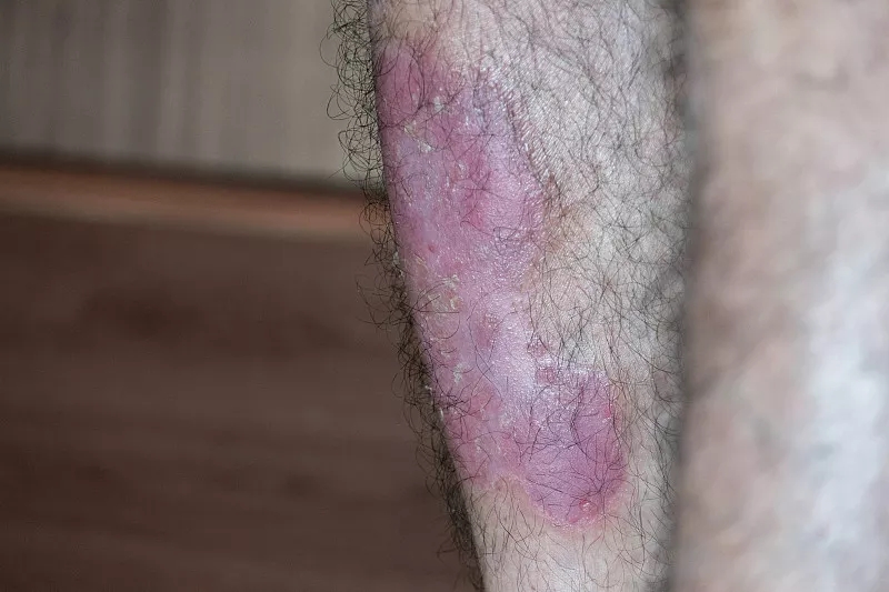 間充質干細胞成功治療斑塊狀銀屑病:案例研究 間充質干細胞成功治療斑塊狀銀屑病:案例研究