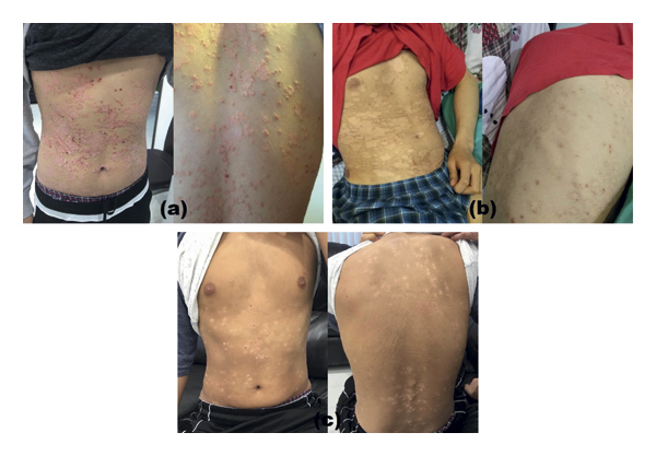 G-MSC輸注對一名有5年嚴重斑塊狀銀屑病病史的19歲男性的影響。 G-MSC輸注對一名有5年嚴重斑塊狀銀屑病病史的19歲男性的影響。