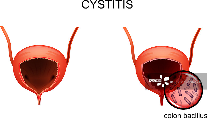 韓國首爾醫(yī)院公布:干細(xì)胞治療間質(zhì)性膀胱炎的I期研究結(jié)果 韓國首爾醫(yī)院公布:干細(xì)胞治療間質(zhì)性膀胱炎的I期研究結(jié)果