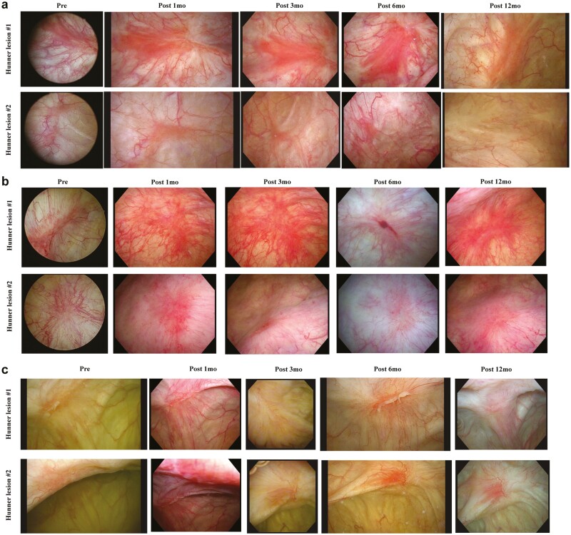 圖1:每位患者Hunner病變的連續(xù)膀胱鏡圖像。 圖1:每位患者Hunner病變的連續(xù)膀胱鏡圖像。