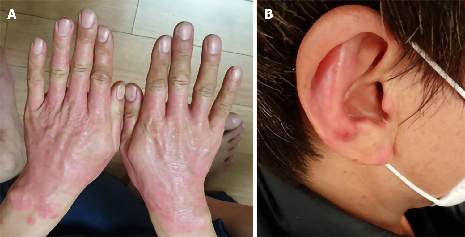 圖1:銀屑病治療前皮損部位。 圖1:銀屑病治療前皮損部位。