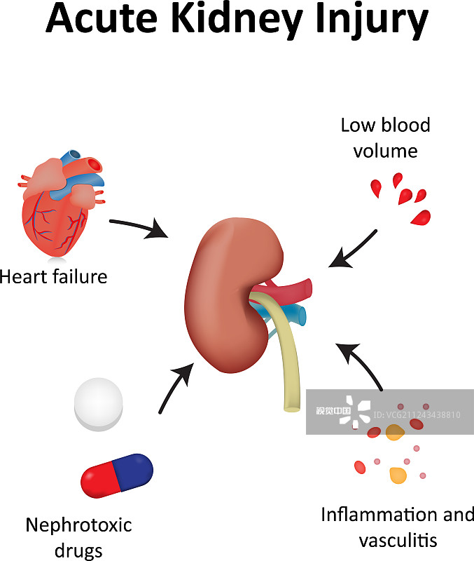 間充質(zhì)干細(xì)胞治療急性腎損傷的臨床研究進(jìn)展