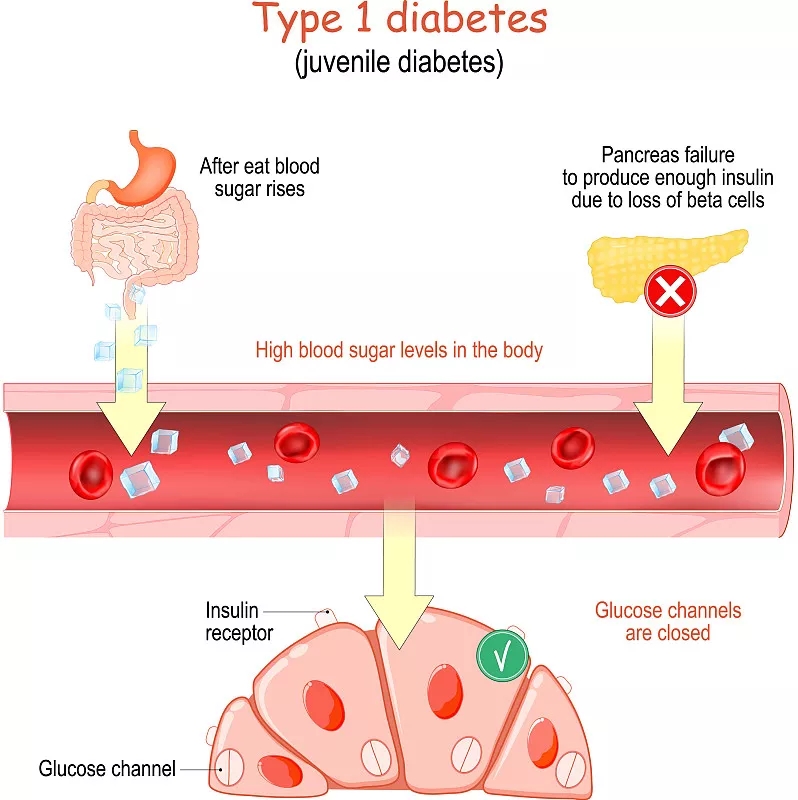 1型糖尿病癥狀有哪些？
