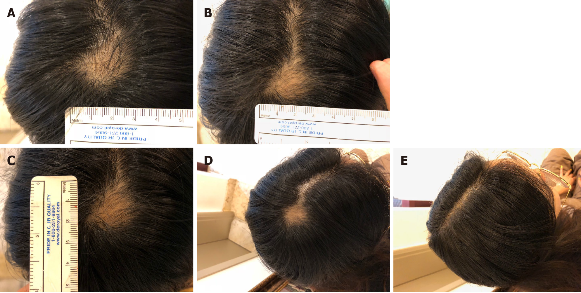 圖4：病例2治療期間和治療后病變部位可見變化。 