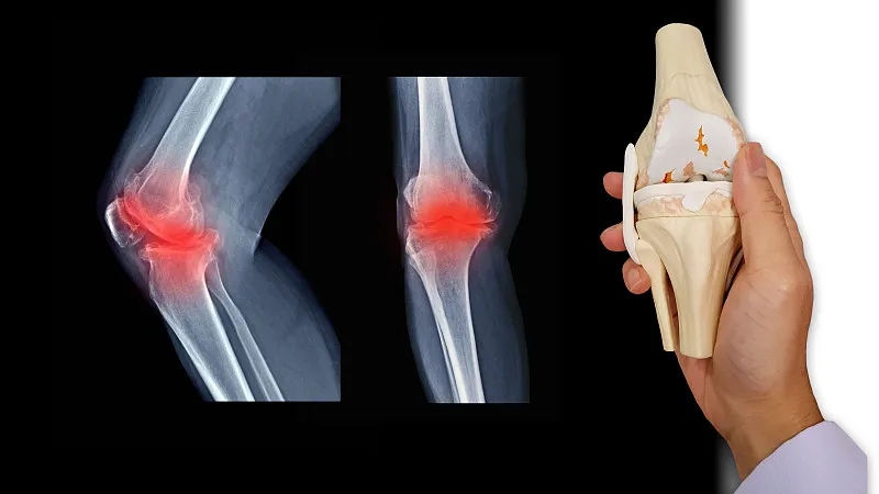 什么是骨關節炎-骨關節炎癥狀有哪些