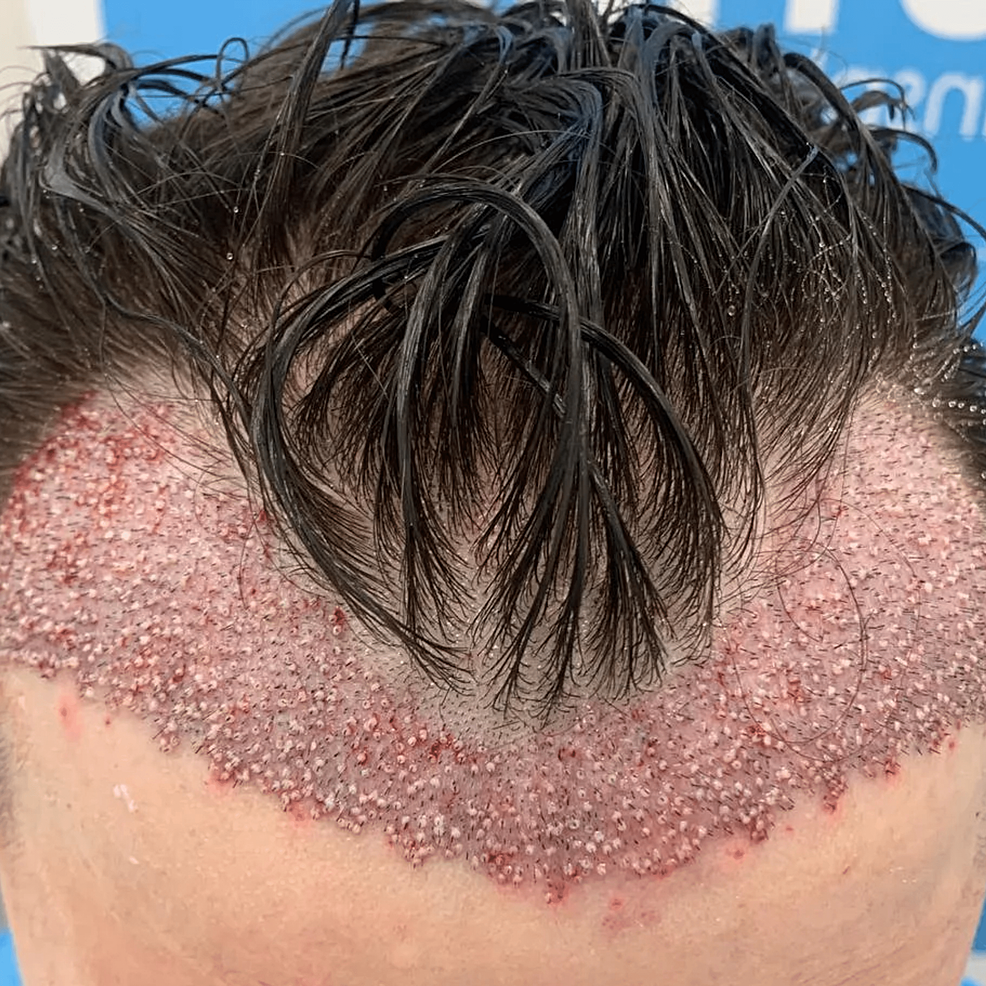 頭發移植手術后即刻的結果。——這允許在患者中建立更豐滿和更前的發際線