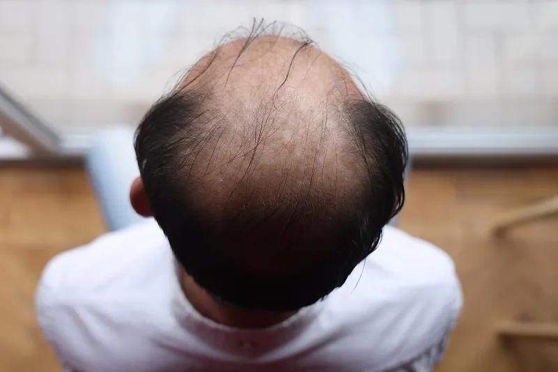 干細(xì)胞治療脫發(fā)的優(yōu)缺點(diǎn) 干細(xì)胞治療脫發(fā)的優(yōu)缺點(diǎn)