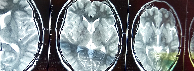 中風患者的干細胞治療 中風患者的干細胞治療