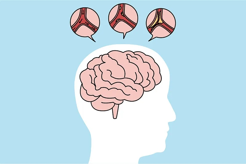 通過比較6、12、24個(gè)月的結(jié)果,來(lái)評(píng)估干細(xì)胞治療缺血性中風(fēng)的有效性和安全性 通過比較6、12、24個(gè)月的結(jié)果,來(lái)評(píng)估干細(xì)胞治療缺血性中風(fēng)的有效性和安全性