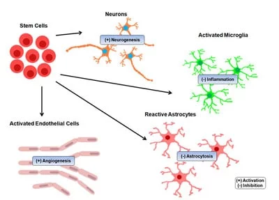 干細胞治療中風的結果