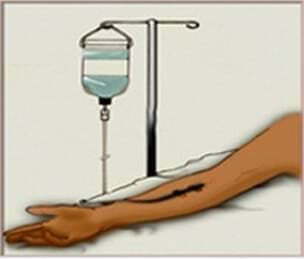 靜脈注射圖像。