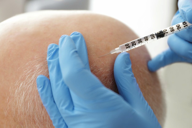 頭發(fā)修復過程是怎樣的？ |  干細胞治療脫發(fā)