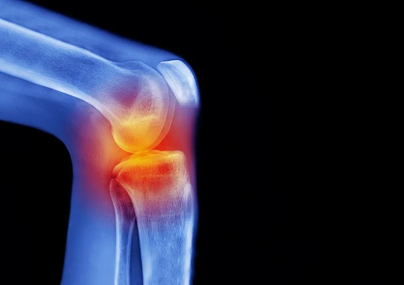 骨關節炎——間充質干細胞在軟骨再生中的作用 骨關節炎——間充質干細胞在軟骨再生中的作用