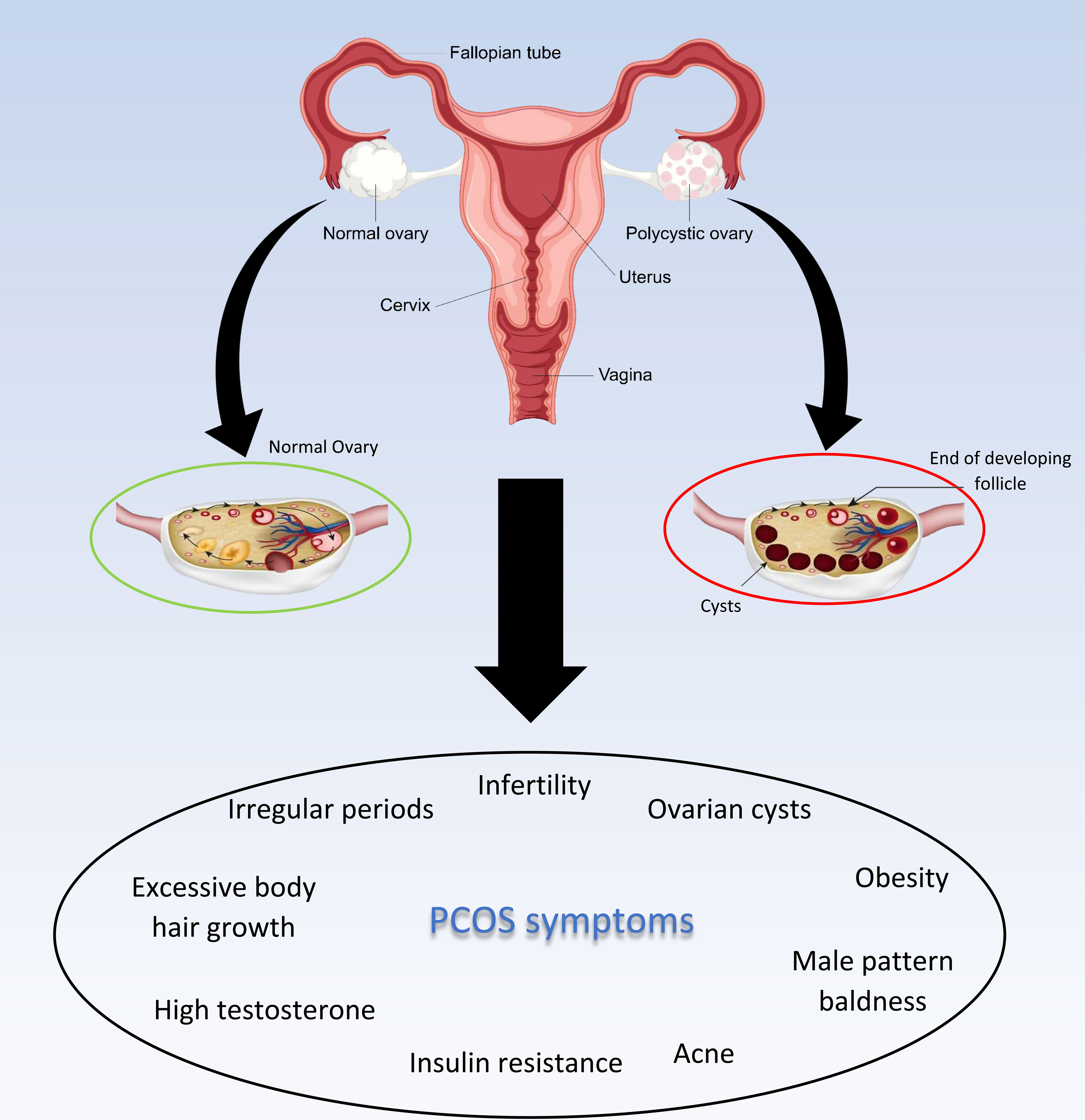 圖2:多囊卵巢綜合癥及其癥狀 圖2:多囊卵巢綜合癥及其癥狀