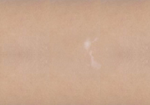 白癜風白斑初期癥狀輕微小斑點,無色素。 白癜風白斑初期癥狀輕微小斑點,無色素。