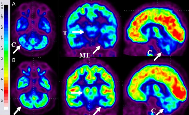 圖6：ASD患者在細胞治療前和細胞治療后6個月進行的FDG-PET/CT大腦掃描的代表性圖像。