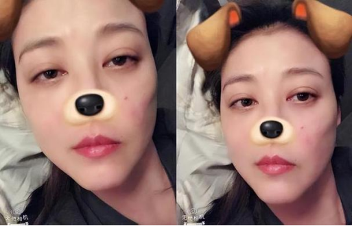 △ 周海媚之前發布的自拍照中也隱約可見面部紅斑 △ 周海媚之前發布的自拍照中也隱約可見面部紅斑