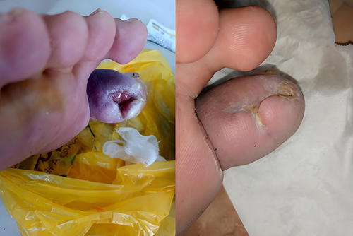 圖4:糖尿病潰瘍修復示例–干預前(左)和干預后(右)。 圖4:糖尿病潰瘍修復示例–干預前(左)和干預后(右)。