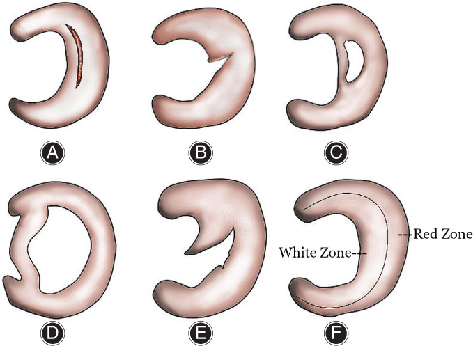圖2:半月板的解剖結(jié)構(gòu)和損傷類型 圖2:半月板的解剖結(jié)構(gòu)和損傷類型