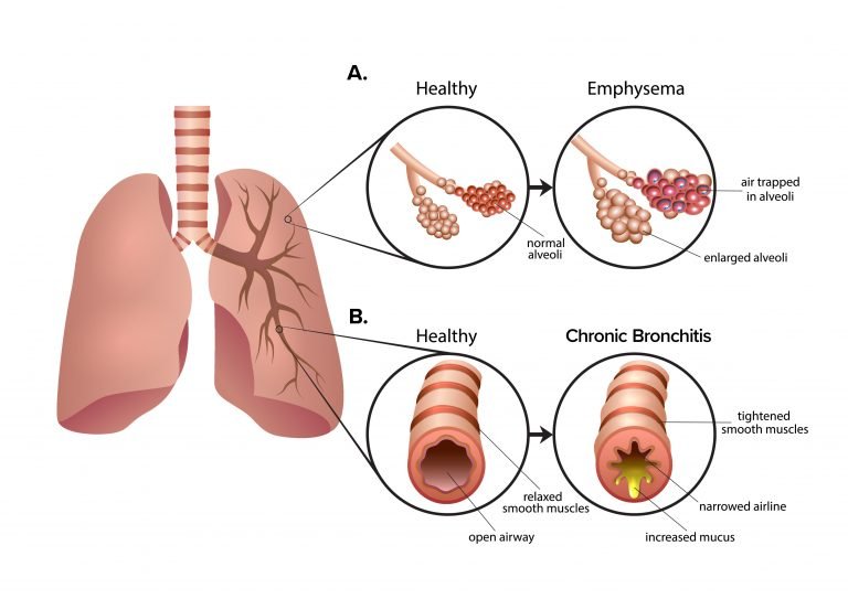 圖2：慢性阻塞性肺疾病 (COPD) 是一組導致呼吸困難的肺部疾病。A.肺氣腫導致肺泡氣囊受損和僵硬。空氣被困在肺泡中，導致呼氣困難。B.慢性支氣管炎會導致氣道腫脹和粘液增多。多余的粘液使呼吸困難并導致慢性咳嗽