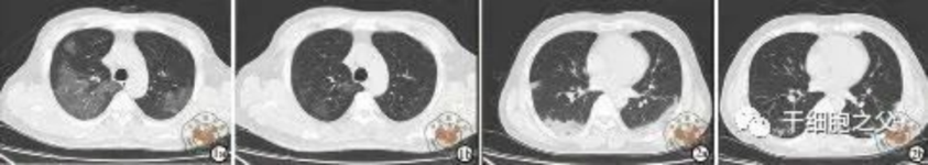 細(xì)胞輸注后,炎癥指標(biāo)改善,復(fù)查胸部CT提示雙肺病灶較前吸收,呼吸道癥狀改善,新型冠狀病毒核酸檢測連續(xù)2次陰性,治愈出院。 細(xì)胞輸注后,炎癥指標(biāo)改善,復(fù)查胸部CT提示雙肺病灶較前吸收,呼吸道癥狀改善,新型冠狀病毒核酸檢測連續(xù)2次陰性,治愈出院。