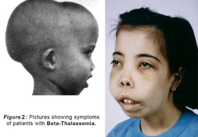 重型β地中海貧血是一種嚴重的遺傳性疾病,給患兒帶來了長期的痛苦和折磨 重型β地中海貧血是一種嚴重的遺傳性疾病,給患兒帶來了長期的痛苦和折磨