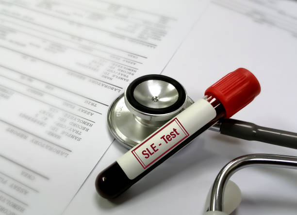 臍帶干細胞可以幫助狼瘡患者嗎？