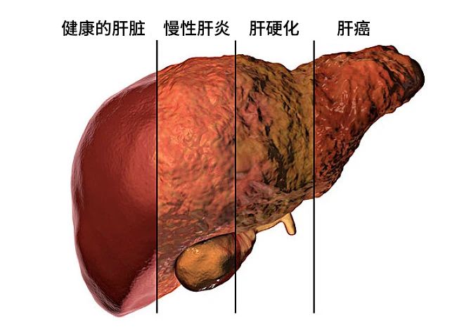 不同原因的肝損害發(fā)展主要分為三個(gè)階段：肝炎-肝硬化-肝癌。