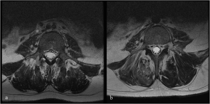圖1：6號患者輸注前和輸注后MRI。
