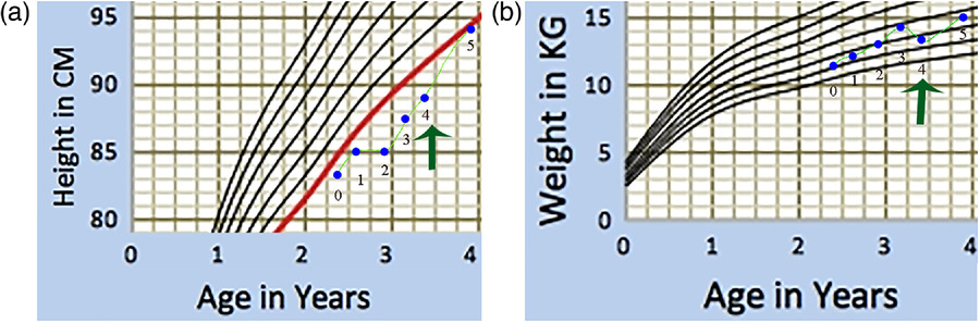 圖1：一名患有嚴重III型OI的男孩的生長曲線圖。