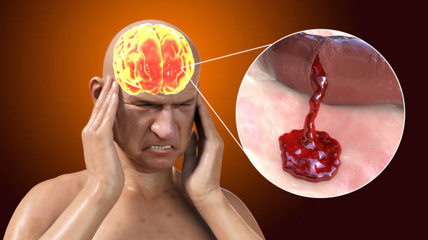 了解缺血性中風的病理生理學：當前療法的基礎和干細胞療法的機遇