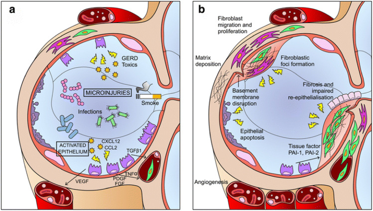 圖1:IPF發病機制示意圖。 圖1:IPF發病機制示意圖。