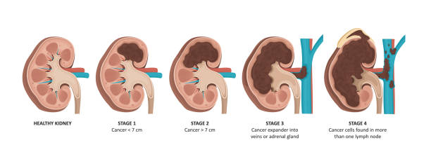 你了解急性腎損傷的3個不同階段嗎? 你了解急性腎損傷的3個不同階段嗎?