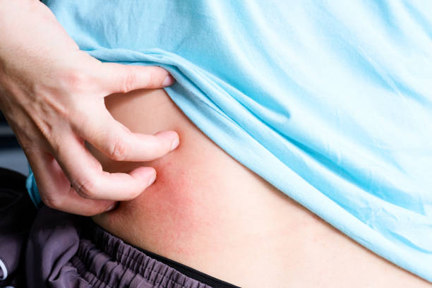 肝硬化肝腎綜合征的診斷、預防和治療 肝硬化肝腎綜合征的診斷、預防和治療