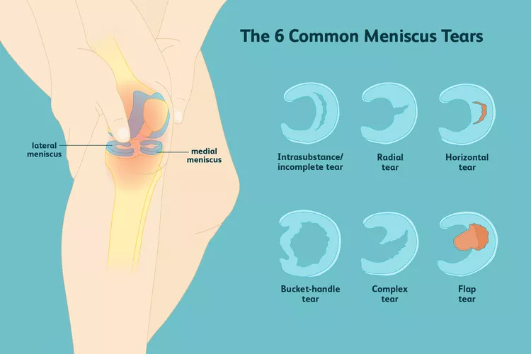 膝關(guān)節(jié)半月板損傷：你了解這六種撕裂類型嗎？