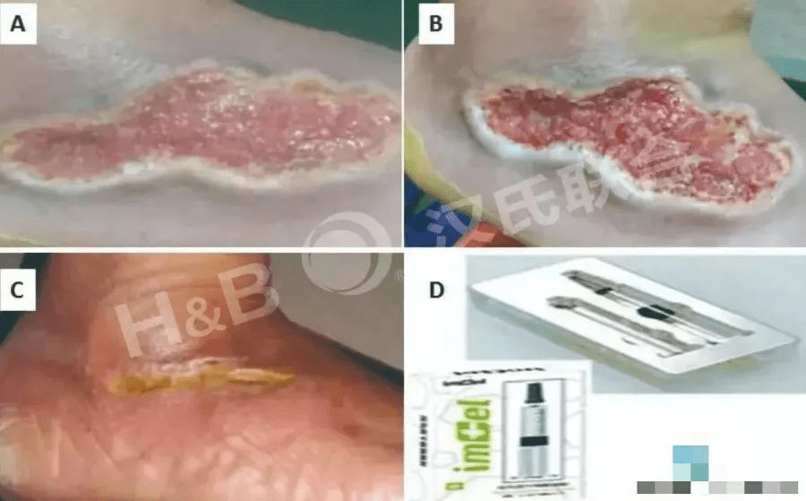 糖尿病足潰瘍患者使用胎盤衍生間充質干細胞水凝膠進行三周局部治療:病例報告。 糖尿病足潰瘍患者使用胎盤衍生間充質干細胞水凝膠進行三周局部治療:病例報告。