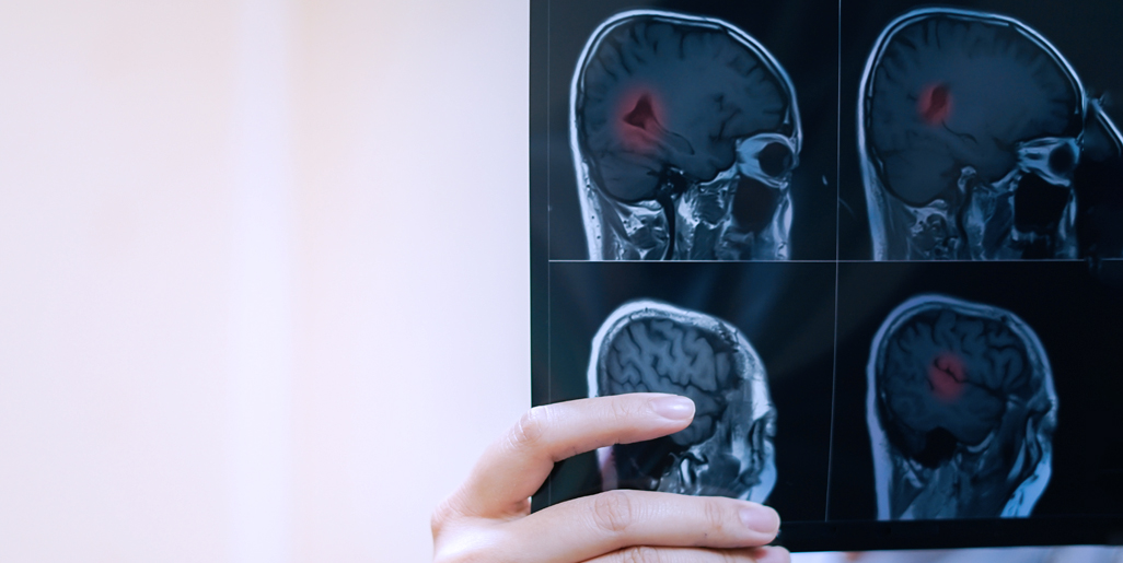 多發(fā)性硬化癥的干細胞療法：探索神經免疫學的新前沿