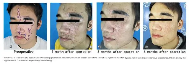 2023年干細胞治療白癜風臨床案例 2023年干細胞治療白癜風臨床案例