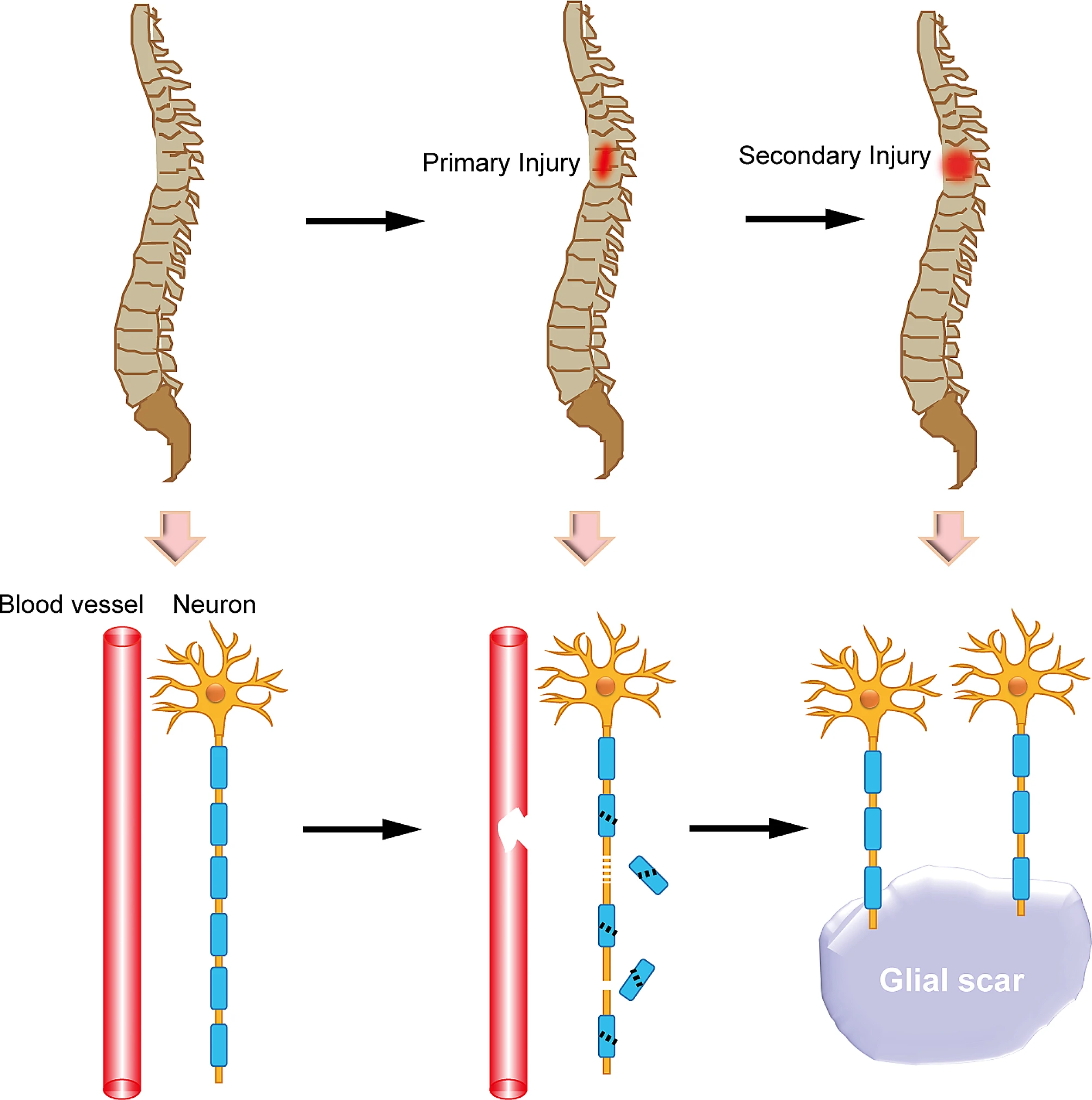 圖1：脊髓損傷后的原發性和繼發性損傷