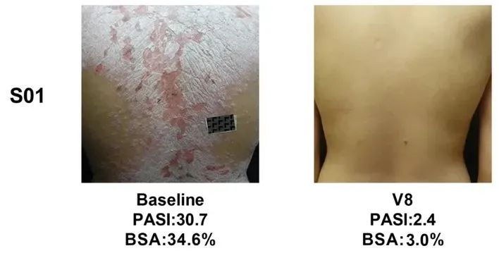 總共47.1% (8/17)的銀屑病患者在PASI（皮損面積和嚴(yán)重程度）評分中有至少40%的改善