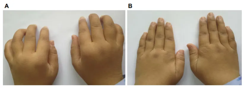 33歲女性，患病4年，治療前后對(duì)比