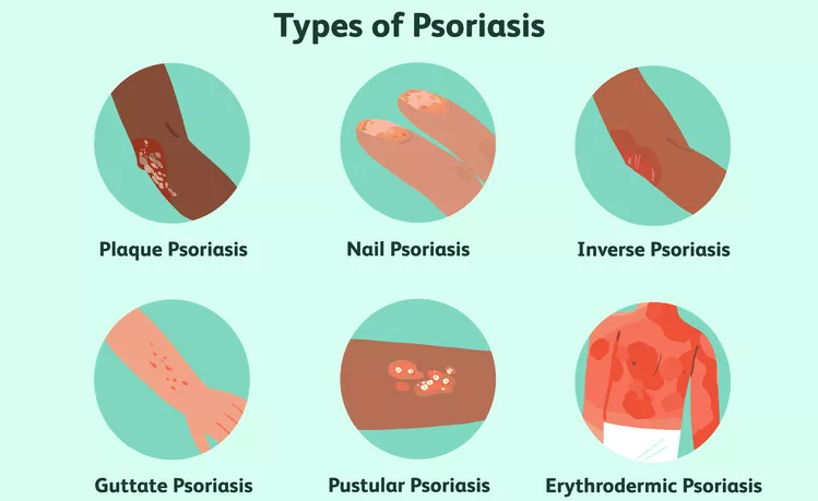 盤點(diǎn)國內(nèi)各大醫(yī)院運(yùn)用干細(xì)胞治療銀屑病的臨床應(yīng)用