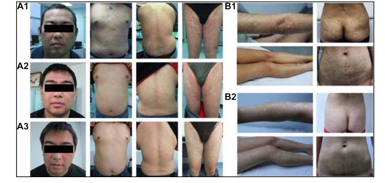 兩例尋常型銀屑病患者通過臍帶間充質(zhì)干細(xì)胞（UC-MSCs）治療，兩例患者均在4至5年內(nèi)未復(fù)發(fā)。