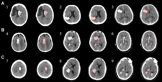 為了描述目的,患者按入組順序被賦予編號,并被連續(xù)分配到三組中的一組,每組三名。 為了描述目的,患者按入組順序被賦予編號,并被連續(xù)分配到三組中的一組,每組三名。