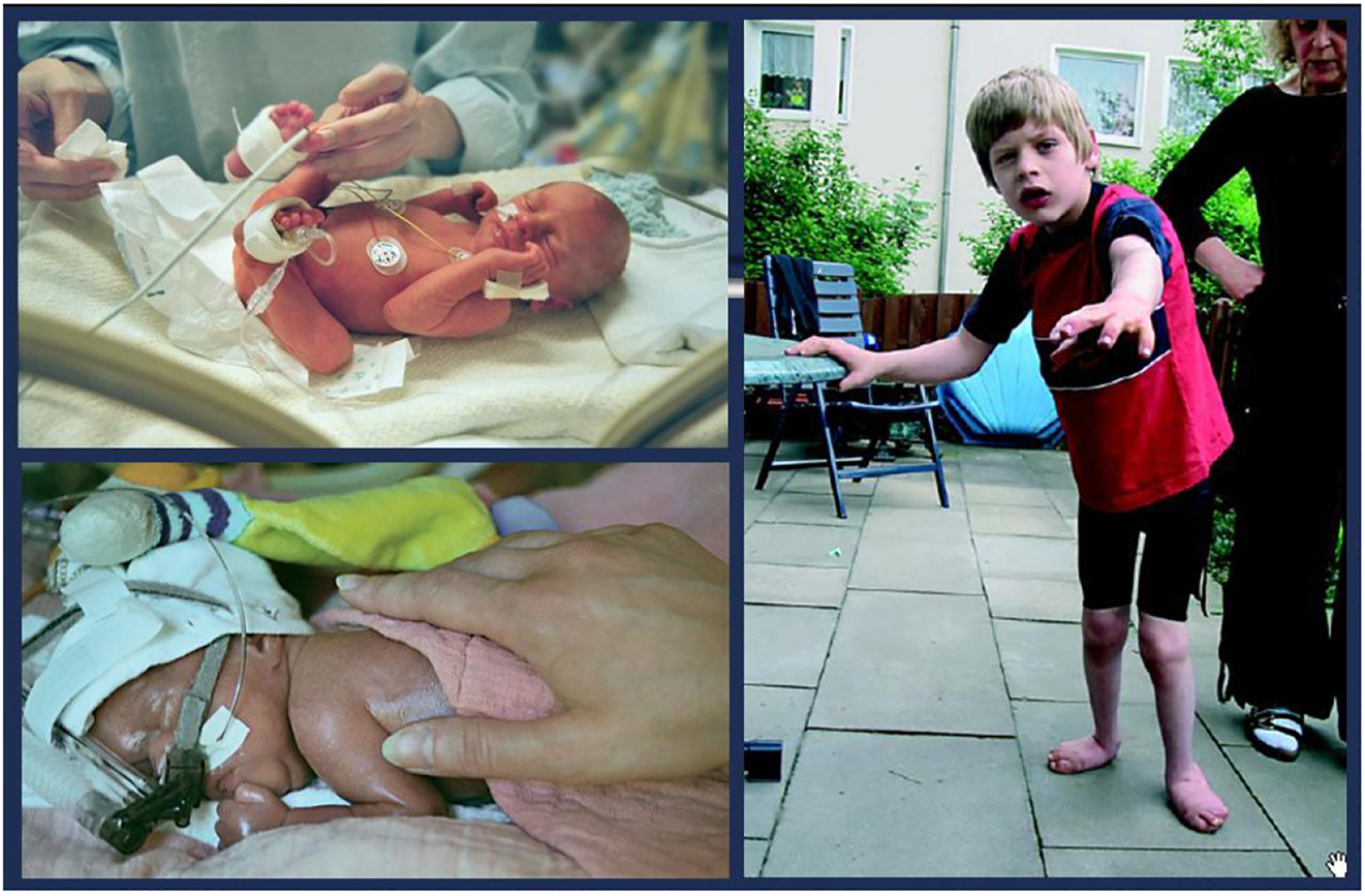 腦癱 (CP) 是兒童期最常見的殘疾，是一種嚴重的非進行性嬰幼兒腦部疾病，具有終身后遺癥