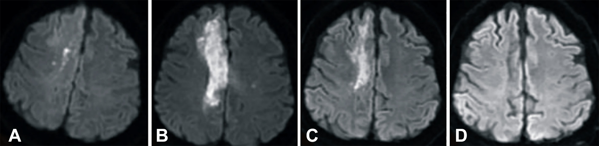 卒中發(fā)病后2小時和單核細胞臍帶血輸注后6個月獲得的彌散加權(quán)圖像 卒中發(fā)病后2小時和單核細胞臍帶血輸注后6個月獲得的彌散加權(quán)圖像