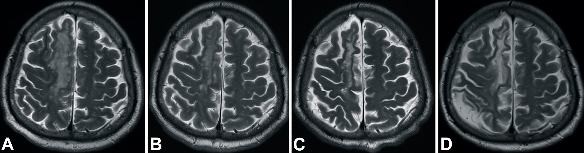 中風(fēng)后2小時和輸血后6個月獲得的T2加權(quán)圖像。 中風(fēng)后2小時和輸血后6個月獲得的T2加權(quán)圖像。