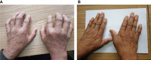 （圖1A）表現(xiàn)為雙手不能伸直。

（圖1B）治療3年后，停用抗風(fēng)濕藥物5年，雙手伸展自如，關(guān)節(jié)周圍風(fēng)濕結(jié)節(jié)逐漸變軟、消退。