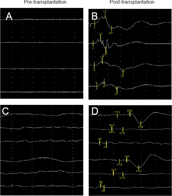 神經(jīng)電生理學(xué)改善 神經(jīng)電生理學(xué)改善