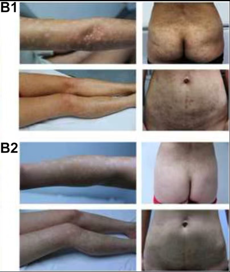 （圖B1）患者入院后體檢發現，患者全身遍布橙紅色斑塊，上面覆有銀色鱗屑

（圖B2）治療初期，我院給予患者3次臍帶間充質干細胞，連續3周回輸，患者全身表面逐漸恢復光滑